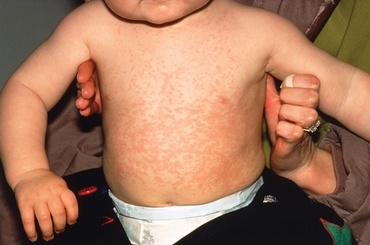 Recunoaste bolile copilariei (I)