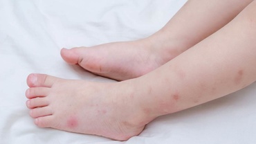 Intepaturile de insecte – descriere si tratament