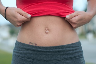 Hernia ombilicala post-partum