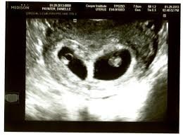 Sindromul geamanului care dispare