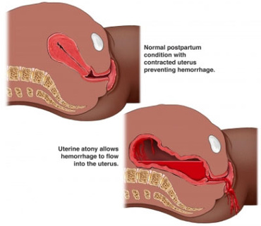 Hemoragia postpartum