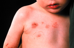 Neutropenia la copii