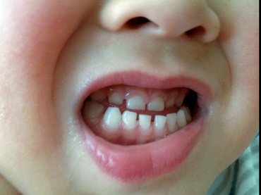 Bruxismul in copilarie: cauze si efecte