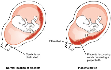 Cum se diagnosticheaza placenta praevia