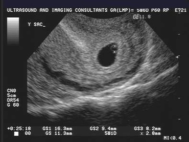 Prima ecografie a sarcinii