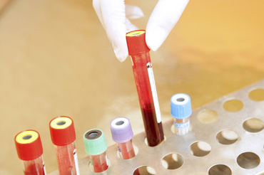 Testele sangvine pot sa reduca numarul deceselor cauzate de cancerul ovarian