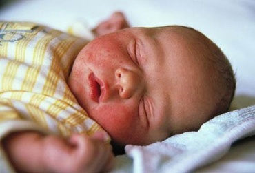 Dermatită atopică: prin ce-am trecut noi şi nu vă dorim nici vouă