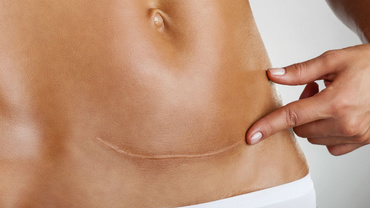 Cezariana: 5 lucruri pe care nimeni nu ți le spune