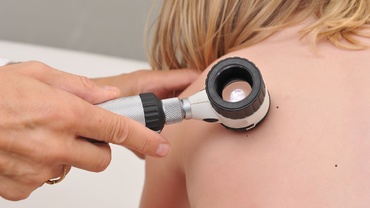 Aluniţele la copii. Când este cazul unui consult la dermatolog