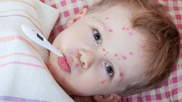 Cum ne ajutăm copiii să treacă prin varicelă și bolile copilăriei
